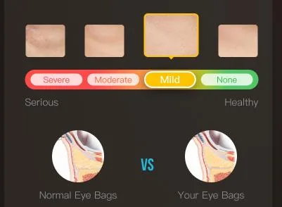 Eye bag grading