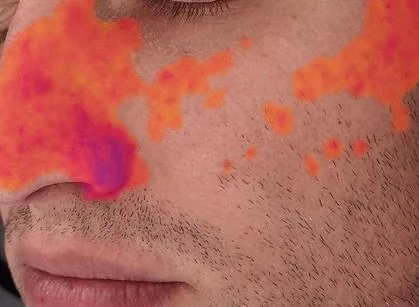 Redness analysis upgrade